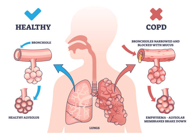 Chronic obstructive pulmonary disease: Fact sheet